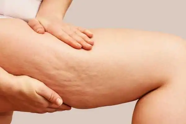Image of woman showing leg with cellulite Kirkcaldy