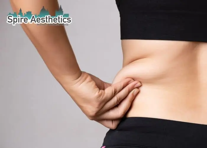 Image of woman pinching fat on their hips Kirkcaldy. Fat Freezing treatment