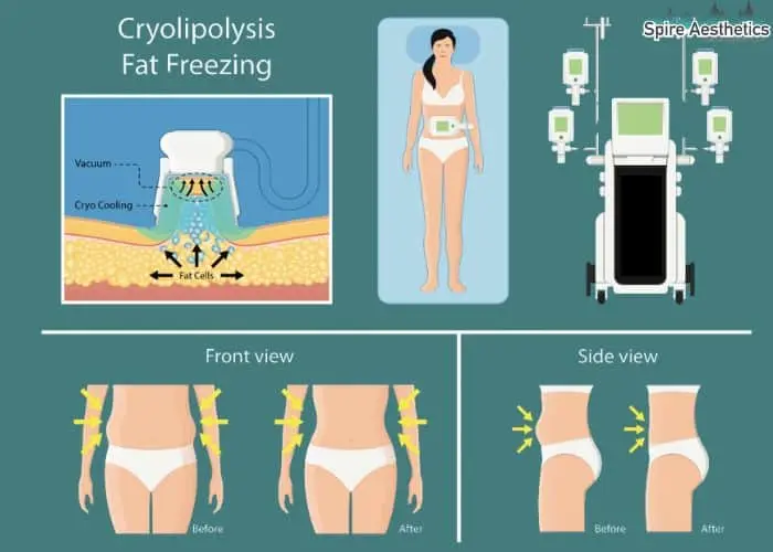 Fat freezing treatment Kirkcaldy benefits for competitions to remove stubborn fat deposits.