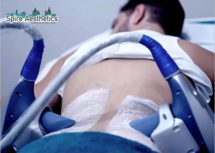 Man having fat freezing treatment done on love handles before a competitions Kirkcaldy to create a sculpted look.
