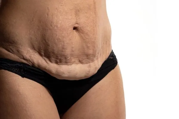 Image of womans stomach after weight loss injections Kirkcaldy showing saggy skin